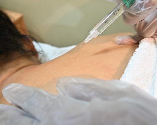 Glucopuncture-3
